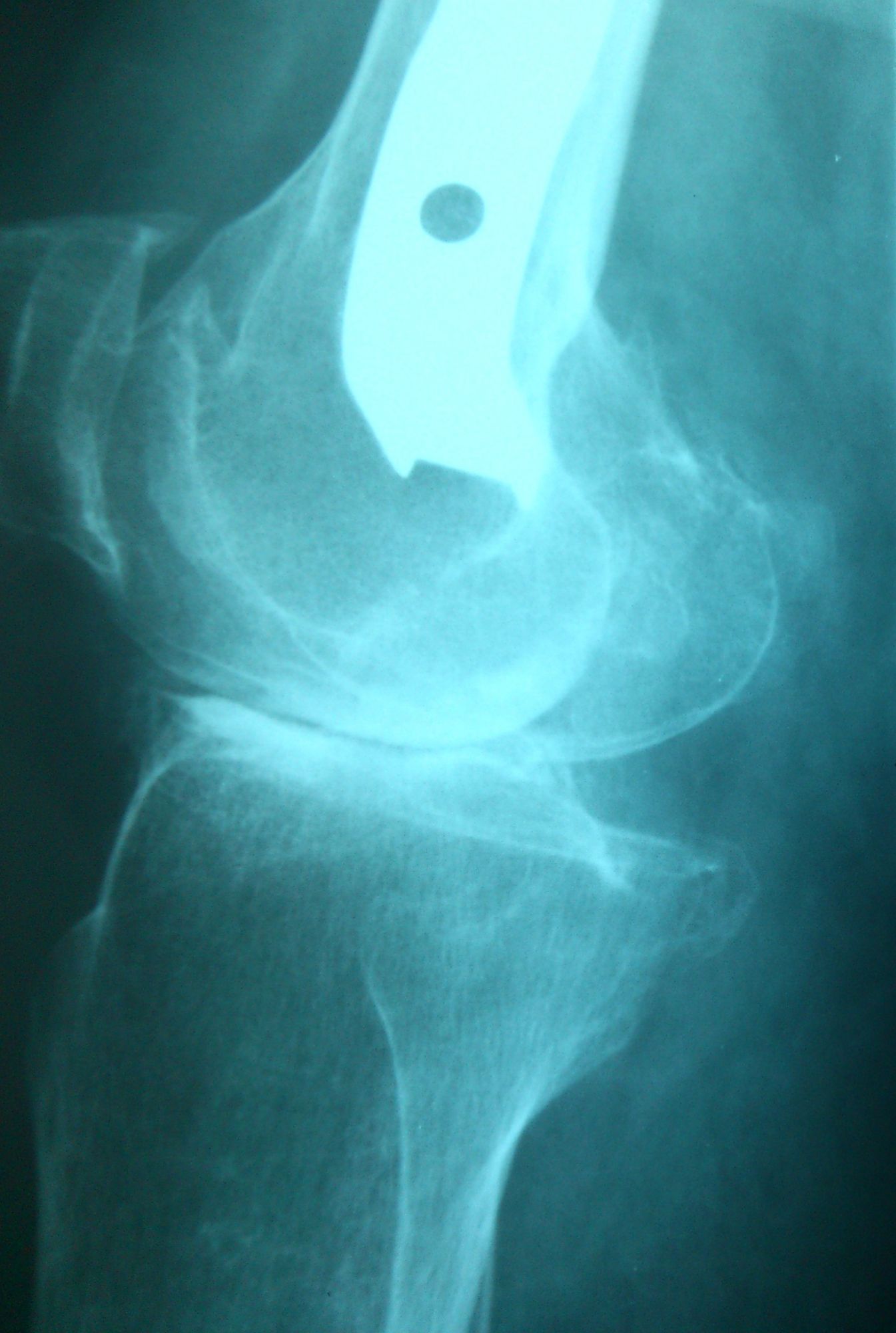 Δύσκολη ολική αρθροπλαστική σε γόνατο που έχει χειρουργηθεί για υπερκονδύλιο κάταγμα - Φωτο1 πριν