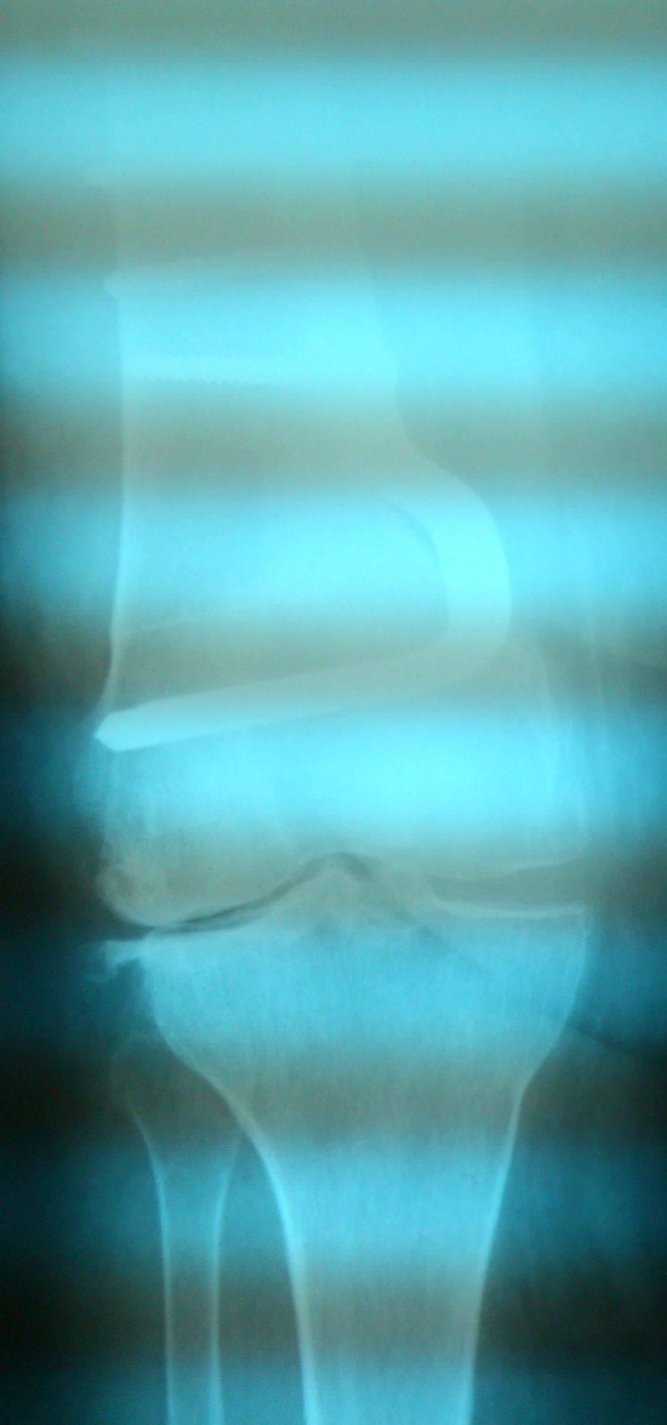 Δύσκολη ολική αρθροπλαστική σε γόνατο που έχει χειρουργηθεί για υπερκονδύλιο κάταγμα - Φωτο1 μετά